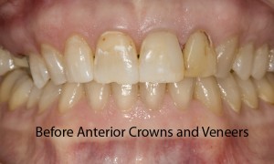 anterior-veneer-3-abefore-fixed-300x180.