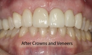 anterior-veneer-3-after-fixed-300x180.jp