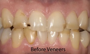 anterior-veneers-abefore-fixed-300x180.j