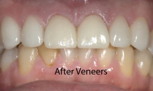 anterior-veneers-after-fixed-300x180.jpg