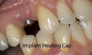 implant-abefore-fixed-300x180.jpg#asset: