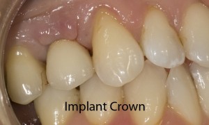 implant-after-fixed-300x180.jpg#asset:62