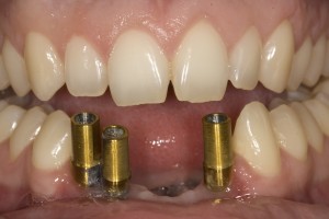 implant-bridge-before-fixed1-300x200.jpg