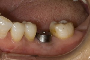 implant-healing-abutment-fixed1-300x200.