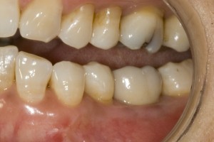 implant-molar-crown-fixed1-300x200.jpg#a